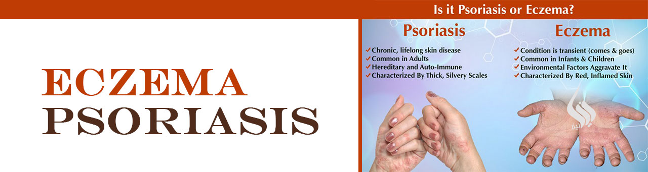 پسوریازیس و اگزما-شرکت تجهیزان پزشکی نیک لیزر
